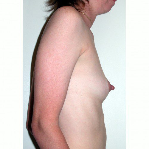 Breast Augmentation 7 Before Photo