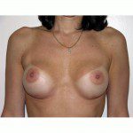 Breast Augmentation 8 After Photo - 10
