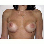 Breast Augmentation 8