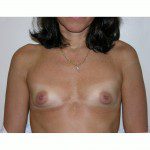Breast Augmentation 8 Before Photo - 7