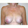 Breast Augmentation 9 After Photo Thumbnail