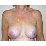 Breast Augmentation 9 After Photo - 9