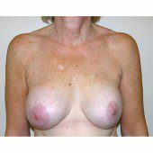 Breast Augmentation 9