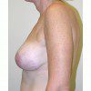 Breast Augmentation 9 After Photo Thumbnail