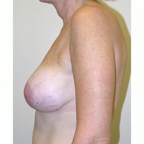 Breast Augmentation 9 After Photo