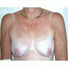 Breast Augmentation 9 Before Photo Thumbnail