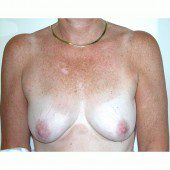 Breast Augmentation 9