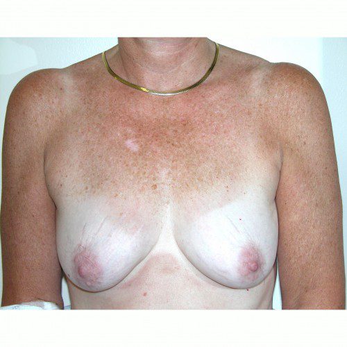 Breast Augmentation 9 Before Photo 