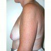 Breast Augmentation 9 Before Photo Thumbnail