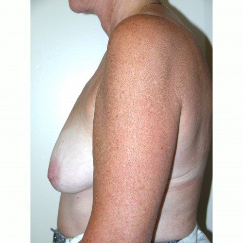 Breast Augmentation 9 Before Photo