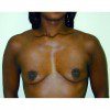 Breast Augmentation 15 Before Photo Thumbnail