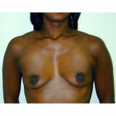 Breast Augmentation 15