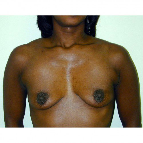 Breast Augmentation 15 Before Photo 