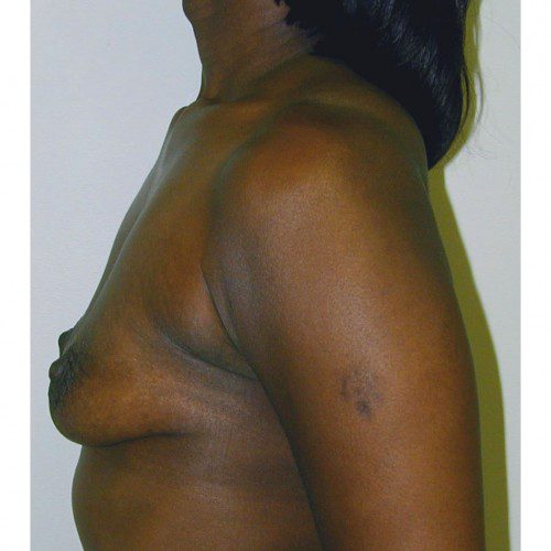 Breast Augmentation 15 Before Photo