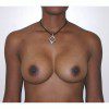 Breast Augmentation 10 After Photo Thumbnail