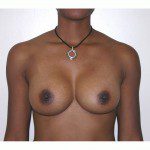 Breast Augmentation 10 After Photo - 8