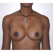 Breast Augmentation 10
