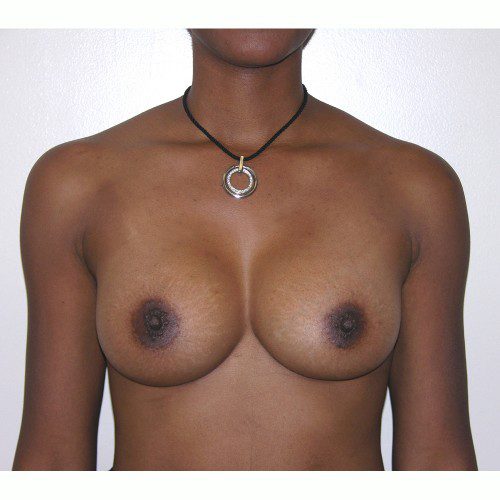 Breast Augmentation 10 After Photo 