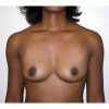 Breast Augmentation 10 Before Photo Thumbnail