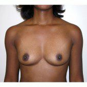 Breast Augmentation 10