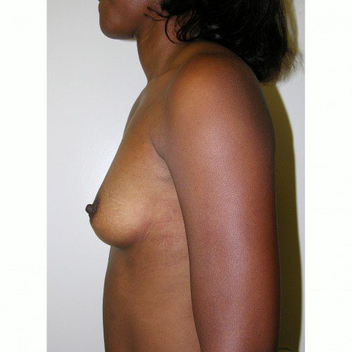 Breast Augmentation 10 Before Photo