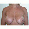 Breast Augmentation 11 After Photo Thumbnail