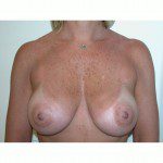 Breast Augmentation 11 After Photo - 4