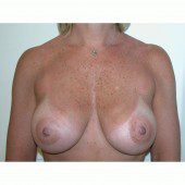 Breast Augmentation 11