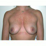 Breast Augmentation 11 Before Photo - 7