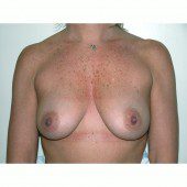 Breast Augmentation 11