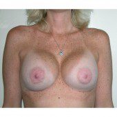 Breast Augmentation 20