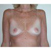 Breast Augmentation 20 Before Photo Thumbnail