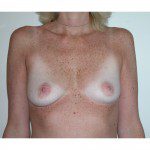 Breast Augmentation 20 Before Photo - 10
