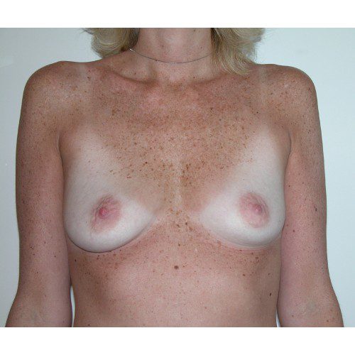 Breast Augmentation 20 Before Photo 