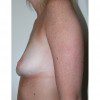 Breast Augmentation 20 Before Photo Thumbnail