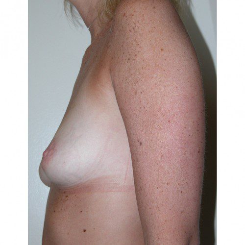 Breast Augmentation 20 Before Photo