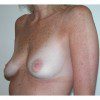 Breast Augmentation 20 Before Photo Thumbnail