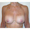 Breast Augmentation 12 After Photo Thumbnail