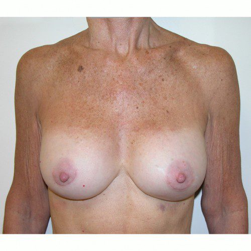 Breast Augmentation 12 After Photo 