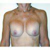 Breast Augmentation 12 Before Photo Thumbnail