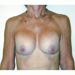 Breast Augmentation 12 Before Photo - 3
