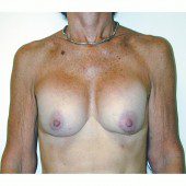 Breast Augmentation 12