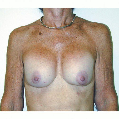 Breast Augmentation 12 Before Photo 