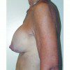 Breast Augmentation 12 Before Photo Thumbnail