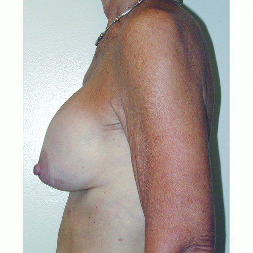 Breast Augmentation 12 Before Photo