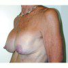 Breast Augmentation 12 Before Photo Thumbnail