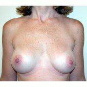 Breast Augmentation 13