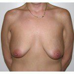 Breast Augmentation 14 Before Photo - 4