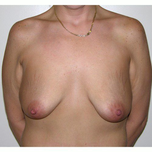 Breast Augmentation 14 Before Photo 