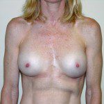 Breast Augmentation 30 After Photo - 12